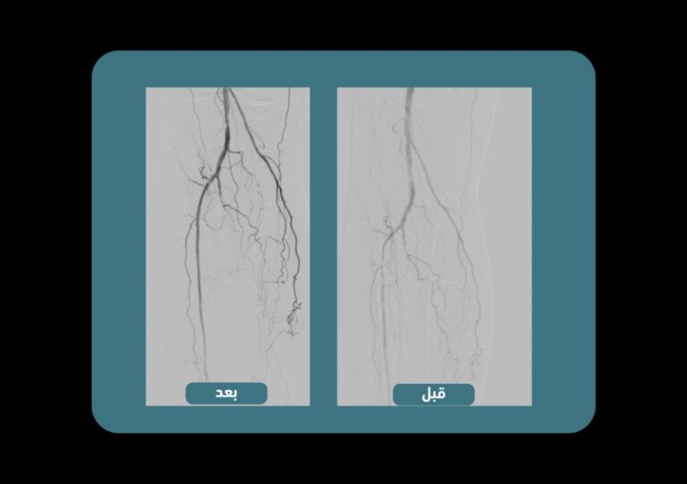 %d9%82%d8%b3%d8%b7%d8%b1%d8%a9 %d8%a7%d9%84%d8%b4%d8%b1%d8%a7%d9%8a%d9%8a%d9%86 %d8%a7%d9%84%d8%b7%d8%b1%d9%81%d9%8a%d8%a9 %d8%aa%d9%86%d9%82%d8%b0 %d9%85%d8%b1%d8%b6%d9%89 %d8%a7%d9%84%d9%82%d8%af