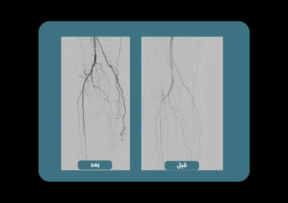 %d9%82%d8%b3%d8%b7%d8%b1%d8%a9 %d8%a7%d9%84%d8%b4%d8%b1%d8%a7%d9%8a%d9%8a%d9%86 %d8%a7%d9%84%d8%b7%d8%b1%d9%81%d9%8a%d8%a9 %d8%aa%d9%86%d9%82%d8%b0 %d9%85%d8%b1%d8%b6%d9%89 %d8%a7%d9%84%d9%82%d8%af