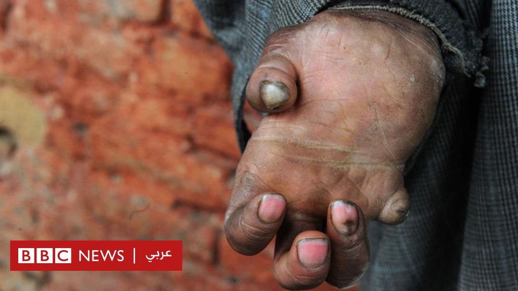 %d8%a7%d9%84%d8%ac%d8%b0%d8%a7%d9%85 %d9%85%d8%a7 %d8%a7%d9%84%d8%b0%d9%8a %d9%86%d8%b9%d8%b1%d9%81%d9%87 %d8%b9%d9%86 %d8%a7%d9%84%d9%85%d8%b1%d8%b6 %d8%a7%d9%84%d8%b0%d9%8a %d9%84%d8%a7 %d9%8a