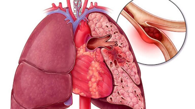 %d8%aa%d9%84%d9%88%d8%ab %d8%a7%d9%84%d9%87%d9%88%d8%a7%d8%a1 %d9%8a%d8%b3%d8%a8%d8%a8 %d8%a7%d9%84%d8%a7%d9%86%d8%b3%d8%af%d8%a7%d8%af %d8%a7%d9%84%d8%b1%d8%a6%d9%88%d9%8a %d8%a7%d9%84%d9%85%d8%b2