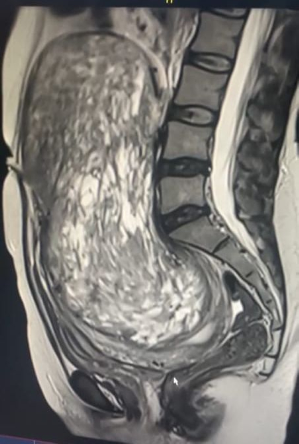 %d8%a7%d8%b3%d8%aa%d8%a6%d8%b5%d8%a7%d9%84 %d9%88%d8%b1%d9%85 %d8%a8%d8%ad%d8%ac%d9%85 %d8%ac%d9%86%d9%8a%d9%86 %d9%85%d9%86 %d8%ab%d9%84%d8%a7%d8%ab%d9%8a%d9%86%d9%8a%d8%a9 %d8%a8%d9%85%d8%af%d9%8a