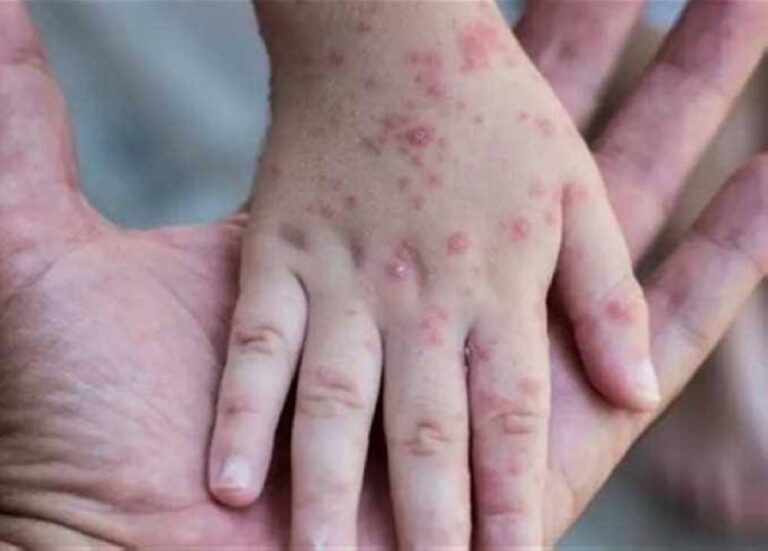 %d8%a7%d9%84%d8%b5%d8%ad%d8%a9 %d8%a7%d9%84%d8%b9%d8%a7%d9%84%d9%85%d9%8a%d8%a9 %d8%aa%d8%b3%d8%ac%d9%8a%d9%84 %d8%a3%d9%83%d8%ab%d8%b1 %d9%85%d9%86 14 %d8%a3%d9%84%d9%81 %d8%ad%d8%a7