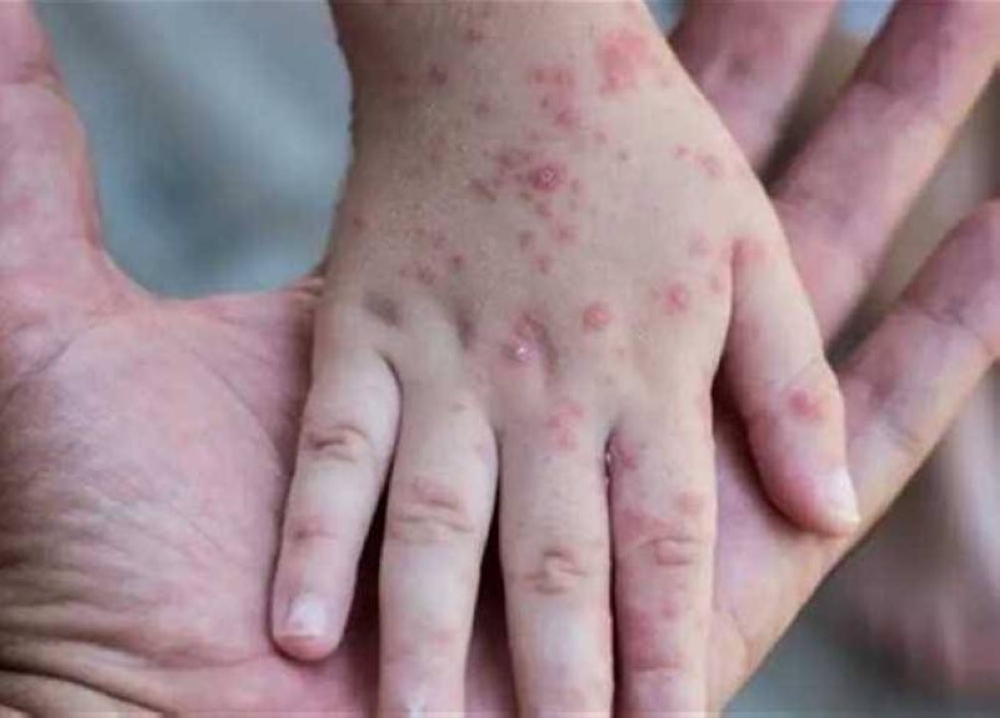 %d8%a7%d9%84%d8%b5%d8%ad%d8%a9 %d8%a7%d9%84%d8%b9%d8%a7%d9%84%d9%85%d9%8a%d8%a9 %d8%aa%d8%b3%d8%ac%d9%8a%d9%84 %d8%a3%d9%83%d8%ab%d8%b1 %d9%85%d9%86 14 %d8%a3%d9%84%d9%81 %d8%ad%d8%a7