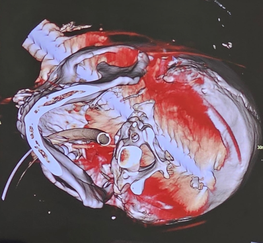 43 %d8%b3%d9%85 %d8%aa%d8%ae%d8%aa%d8%b1%d9%82 %d8%a7%d9%84%d8%b9%d9%85%d9%88%d8%af %d8%a7%d9%84%d9%81%d9%82%d8%b1%d9%8a %d9%81%d8%b1%d9%8a%d9%82 %d8%b7%d8%a8%d9%8a %d9%8a%d9%86%d9%82%d8%b0 %d8%ad