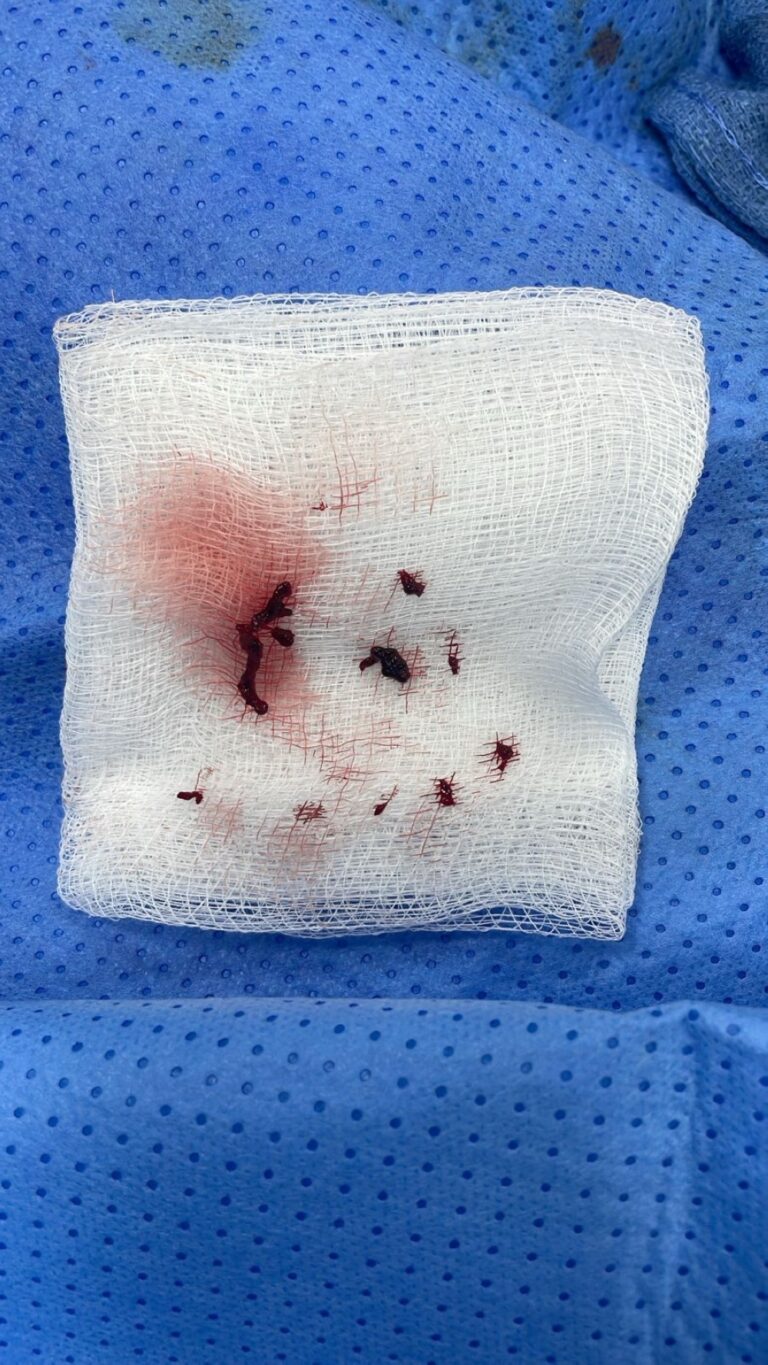 %d8%a5%d9%86%d9%82%d8%a7%d8%b0 %d8%ad%d9%8a%d8%a7%d8%a9 %d9%85%d8%b1%d9%8a%d8%b6 %d8%ab%d9%85%d8%a7%d9%86%d9%8a%d9%86%d9%8a %d9%85%d9%86 %d8%ac%d9%84%d8%b7%d8%a9 %d8%af%d9%85%d8%a7%d8%ba%d9%8a%d8%a9