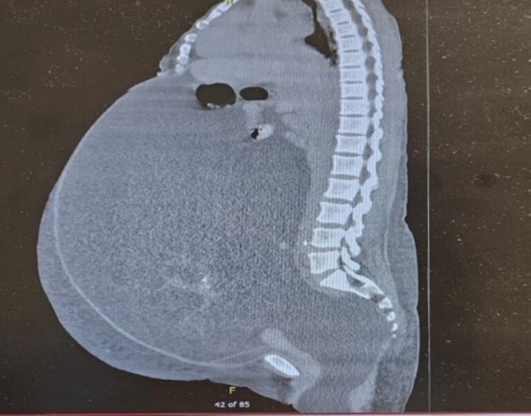 %d8%a7%d8%b3%d8%aa%d8%a6%d8%b5%d8%a7%d9%84 %d9%88%d8%b1%d9%85 %d8%b3%d8%b1%d8%b7%d8%a7%d9%86%d9%8a %d8%b6%d8%ae%d9%85 %d9%85%d9%86 %d8%a8%d8%b7%d9%86 %d9%85%d8%b1%d9%8a%d8%b6%d8%a9 %d8%a8%d8%a7%d9%84