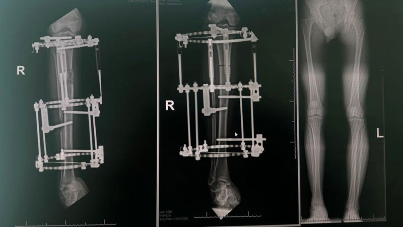 إعلانات ترويجية لـ «تطويل القامة» تستهدف ضحايا التنمر