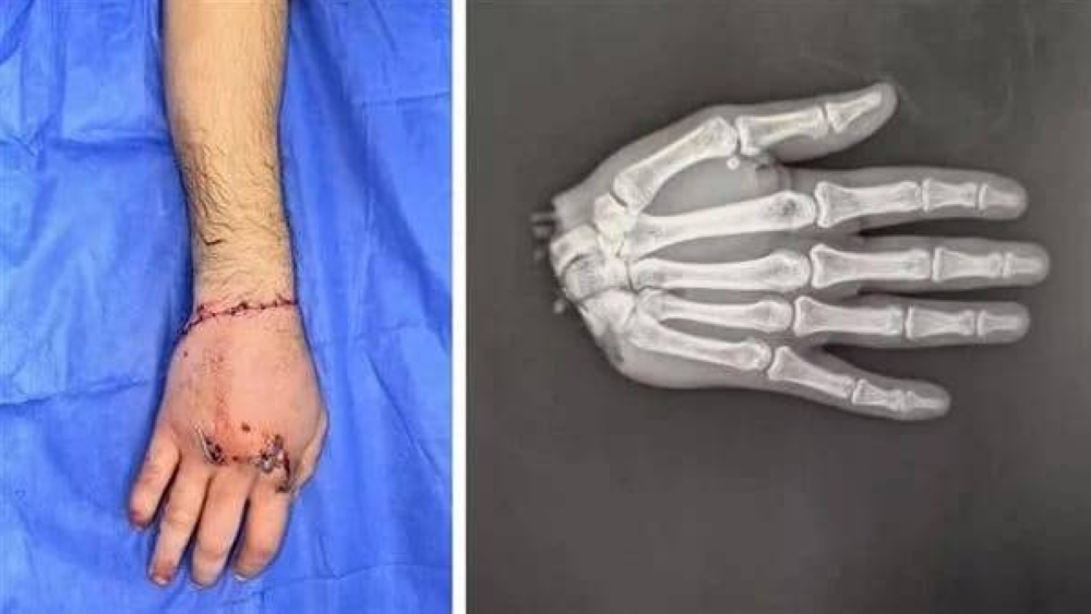 مصر: أطباء يعيدون يد شاب مبتورة