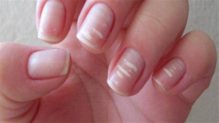 %d8%b9%d9%84%d8%a7%d9%85%d8%a9 %d8%a8%d8%a7%d9%84%d8%a3%d8%b8%d8%a7%d9%81%d8%b1 %d8%aa%d9%83%d8%b4%d9%81 %d8%a5%d8%b5%d8%a7%d8%a8%d8%aa%d9%83 %d8%a8%d8%b3%d8%b1%d8%b7%d8%a7%d9%86 %d9%86%d8%a7%d8%af