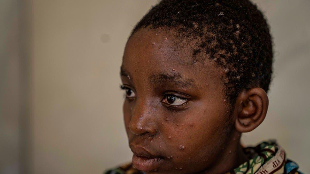 إصابات جديدة بجدري القرود بمزيد من الدول.. ووفيات في أفريقيا