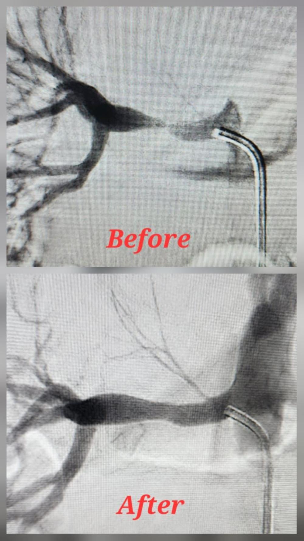 قسطرة نادرة تنهي معاناة طفل من ارتفاع ضغط الدم في المدينة المنورة