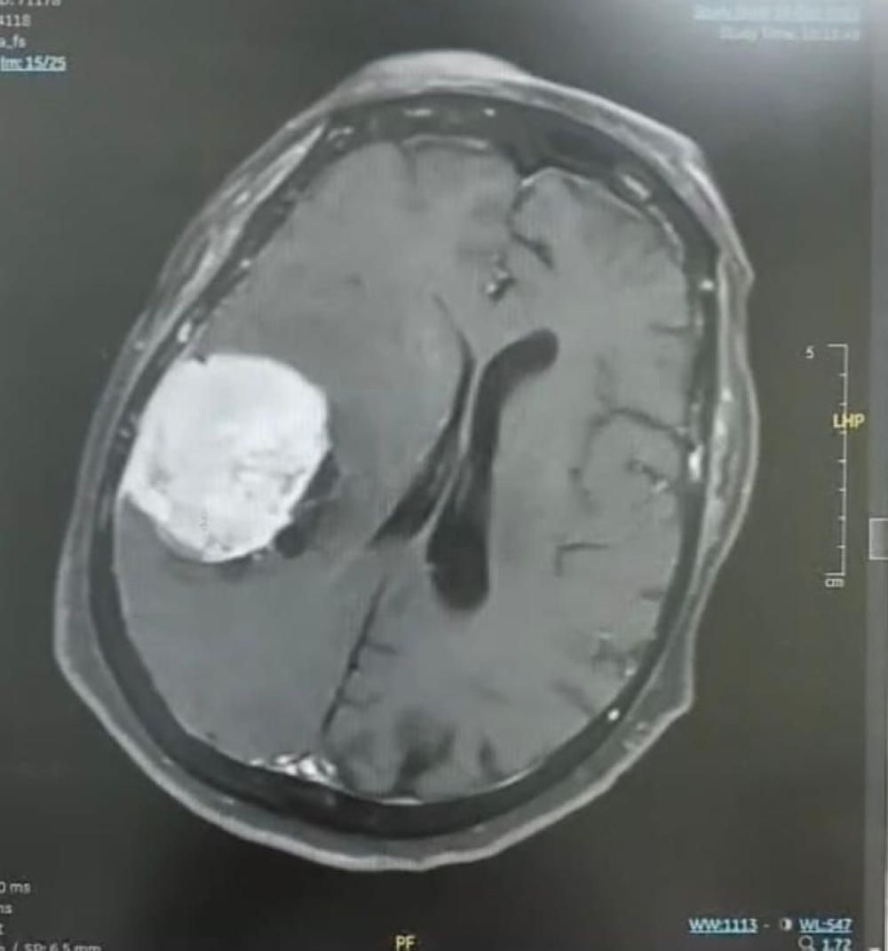 نجاح جراحة لاستئصال ورم دماغي لثمانينية في مستشفى ينبع العام