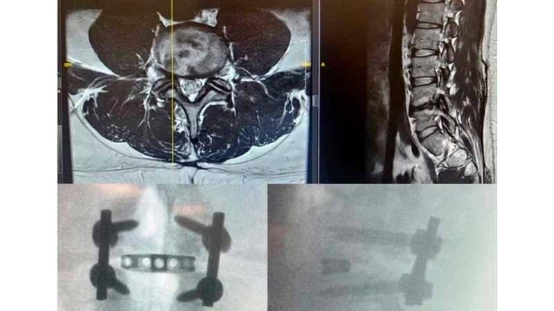 إجراء أول عملية في الشرق الأوسط بتقنية متطورة لتثبيت فقرات الظهر